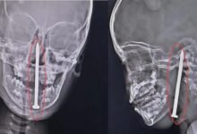 7-yr-old survives after 8 cm nail removed from brain in KGMU