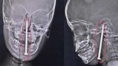 7-yr-old survives after 8 cm nail removed from brain in KGMU